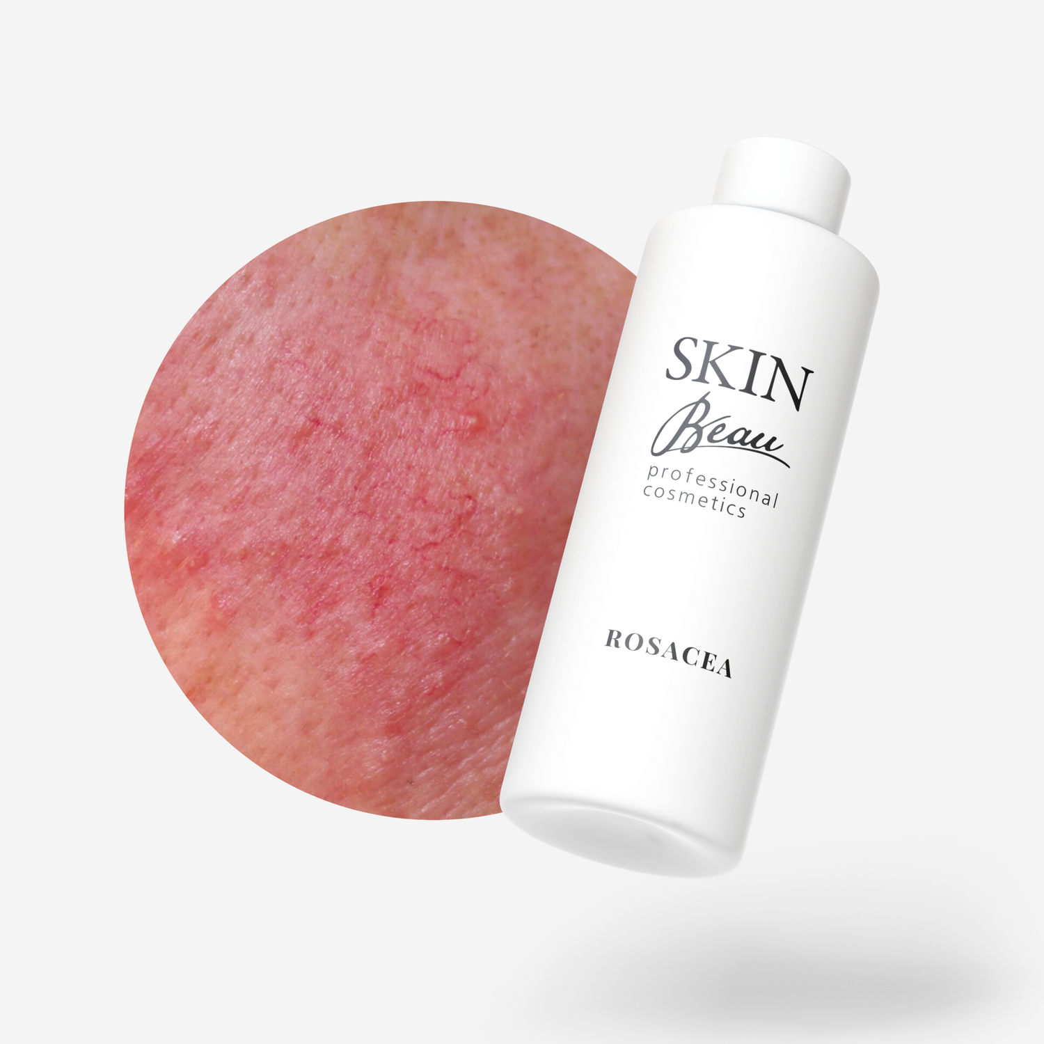 ROSACEA